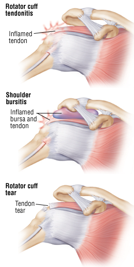 rotator cuff injury diagnosis