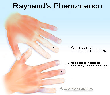 reynolds phenomena symptoms